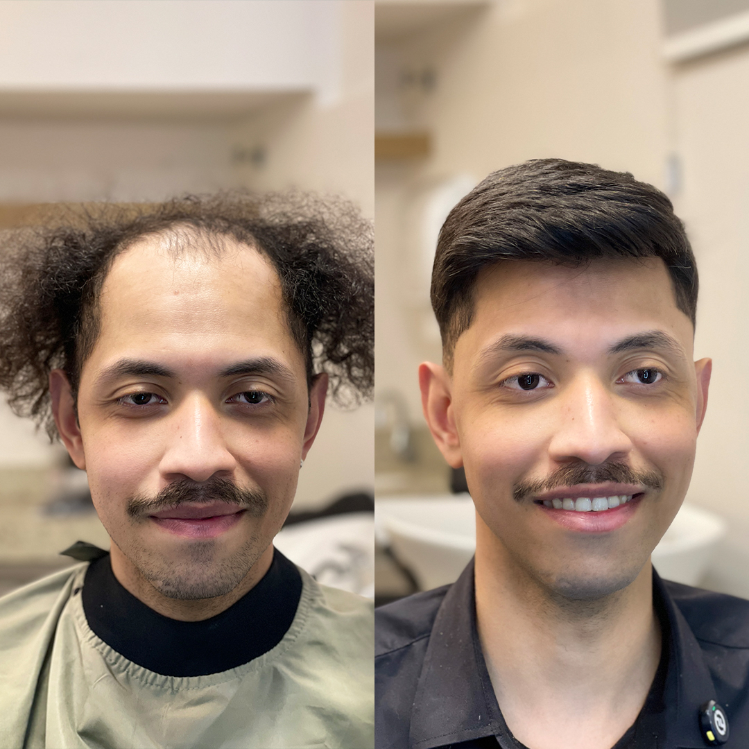 Resultado de prótese capilar Revolux