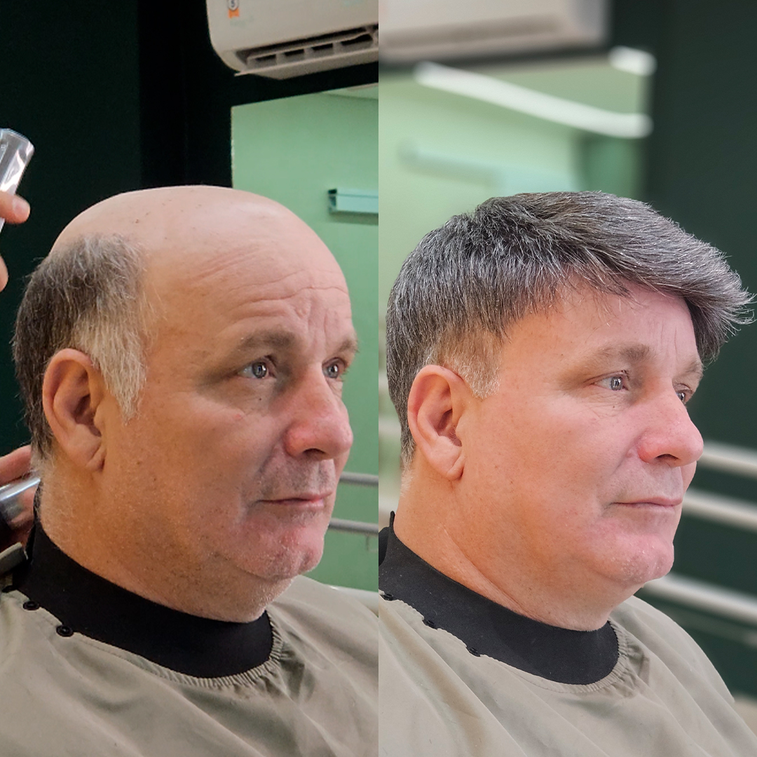 Resultado de prótese capilar Revolux