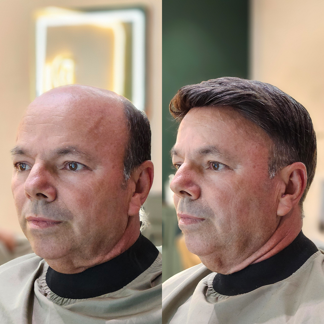 Resultado de prótese capilar Revolux